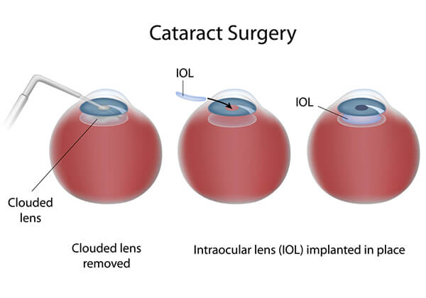 Cataract Surgery Procedure