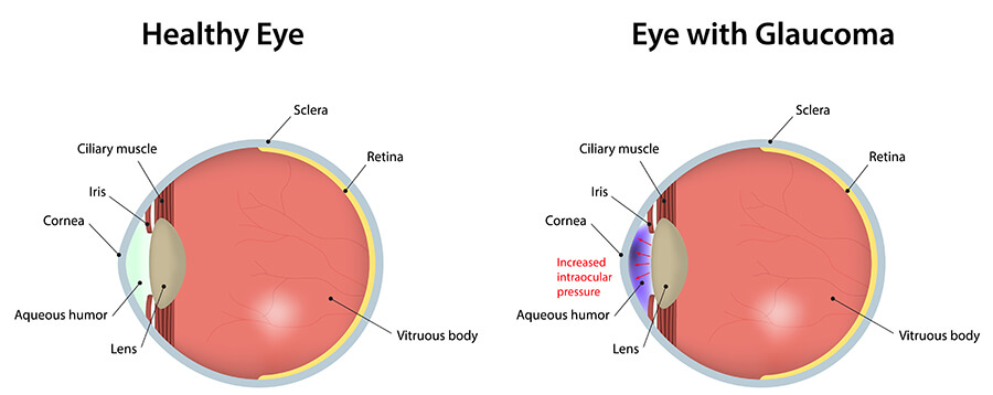 Glaucoma Diagram