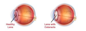 Example of vision with cataracts